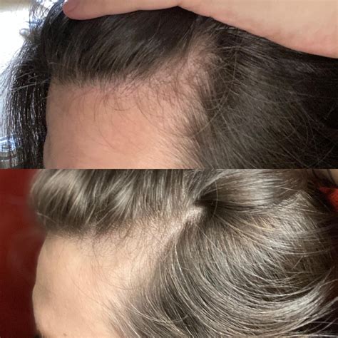 Hair regrowth after mange
